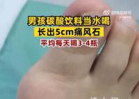 男孩1天4瓶饮料长5厘米痛风石  脚趾关节处已经堆积大量的痛风石