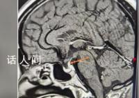 男子每天喝30斤水去50次厕所 连喝茶都是用盆来接