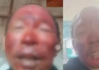 女婿去世女儿住院 男子烧伤不舍就医