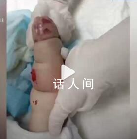 婴儿遇输液渗水起大片红肿水泡 愿小宝宝能尽快痊愈