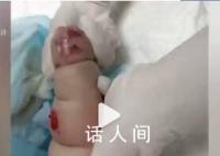 婴儿遇输液渗水起大片红肿水泡 愿小宝宝能尽快痊愈