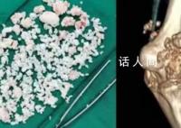 小伙熬夜打游戏关节长千颗白色颗粒 被诊断为滑膜软骨瘤病