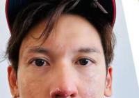 港星关智斌面部手部二级烧伤 好在及时就医目前已经全部康复