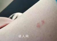 女子花2500住酒店被蛇咬 双方已和解