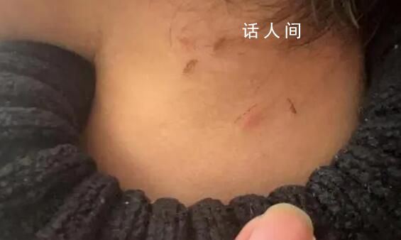 家长称孩子遭老师虐待 身上都是抠痕