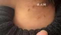 家长称孩子遭老师虐待 身上都是抠痕