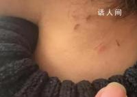 家长称孩子遭老师虐待 身上都是抠痕