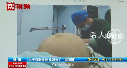 23岁女子腹胀如鼓取出42斤肿瘤 比怀足月双胞胎的孕妇肚子还要大