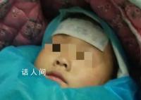4岁女童被3只狗咬掉大半头皮 已在重症监护室治疗一个月