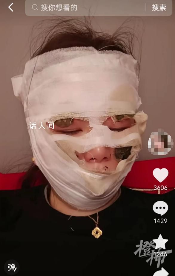 新娘结婚当天被喷雾彩带烫伤 整张脸都被缠满绷带