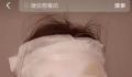 新娘结婚当天被喷雾彩带烫伤 整张脸都被缠满绷带