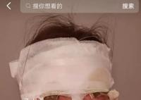新娘结婚当天被喷雾彩带烫伤 整张脸都被缠满绷带