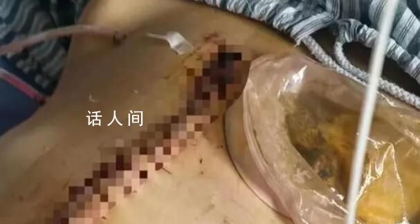 女子被家暴16次需终身挂粪袋案进展 当事人回应