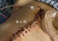 女子被家暴16次需终身挂粪袋案进展 当事人回应