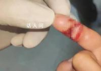 幼童在游乐园手指被夹伤 园方回应