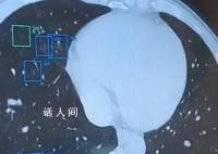 37岁男子肺部发现557个结节 诊断最终倾向早期肺恶性肿瘤