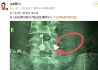 沈梦辰腰椎骨头断裂 第四腰椎左侧横突骨折骨头无法复位