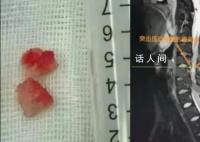 男子在私人工作室按摩险全身瘫痪 两块椎间盘组织掉入椎管中
