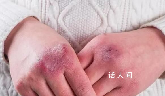 今冬最大寒潮来袭 冻伤记得挂烧伤科