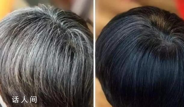 白头发可能是身体给你的警报 白发的生长位置标志着体内脏腑的健康状态