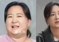 医生称贾玲式减肥要有诊疗团队 即便做减重手术也很难达到这个效果