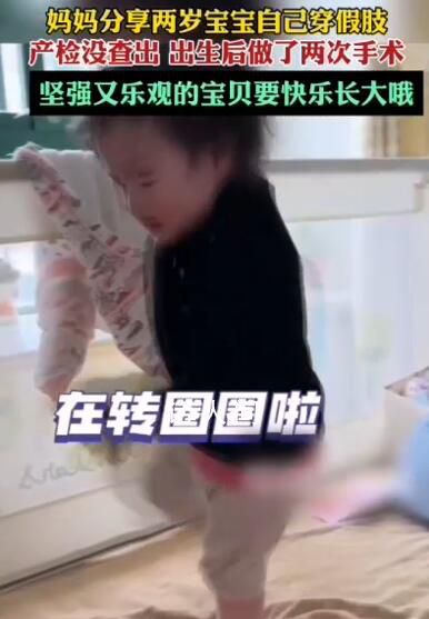 2岁宝宝已穿1年小腿假肢 网友：坚强又乐观的宝贝要快乐长大